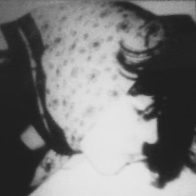 An abstract black-and-white image of two black, wispy blotches on what appears to be mottled skin.