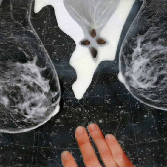 Fingers from a white hand are superimposed over a chart of the solar system. Working their way in from each side of the image are mammogram images of breasts. Seeming to spill from the top of the image is a the white interior of a fruit with four seeds arranged into a diamond shape.