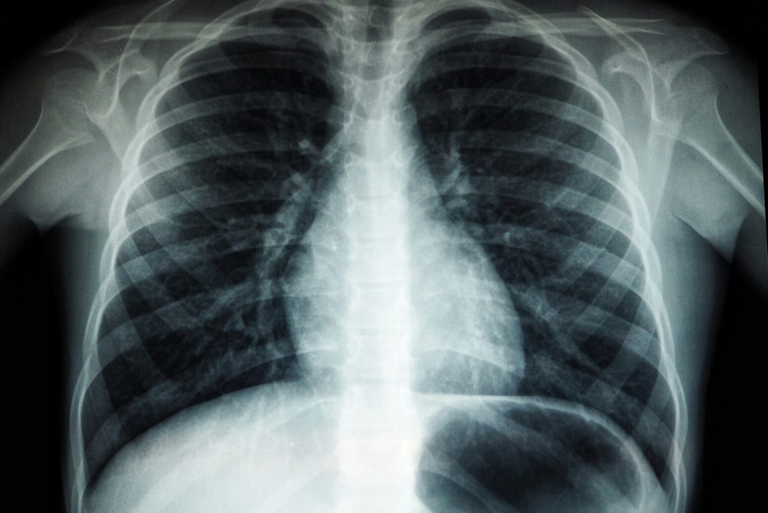 An x-ray of a person's chest. Their ribs, spine, and should bones are visible.